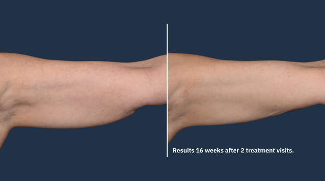 CoolSculpting Elite Arms before and after